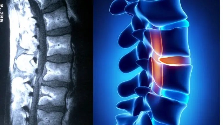 7 Fakta Penting Mengenai Spinal Cord Injury (SCI) Yang Perlu Anda Tahu